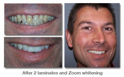 After 2 laminates and Zoom teeth whitening at Wanserski Dental Center for Complex Dentistry in Wausau, WI.