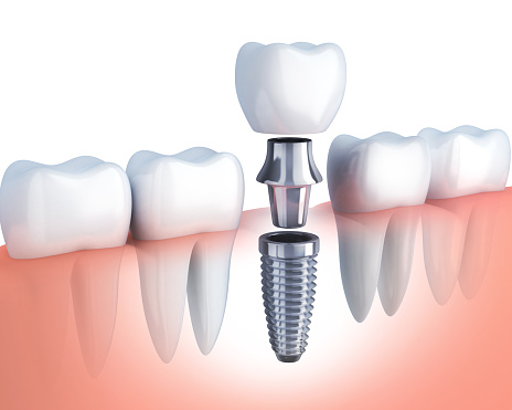Rendering of a single tooth replacement with dental implants at Wanserski Dental Center for Complex Dentistry in Wausau, WI