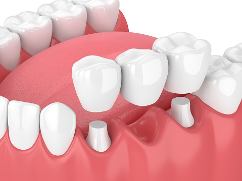 Graphic showing a dental bridge from Wanserski Dental Center for Complex Dentistry in Wausau, WI