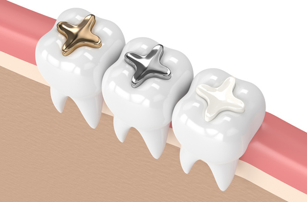 Rendering of teeth with three dental filling materials at Wanserski Dental Center for Complex Dentistry in Wausau, WI Rendering of teeth with three dental filling materials at Wanserski Dental Center for Complex Dentistry in Wausau, WI