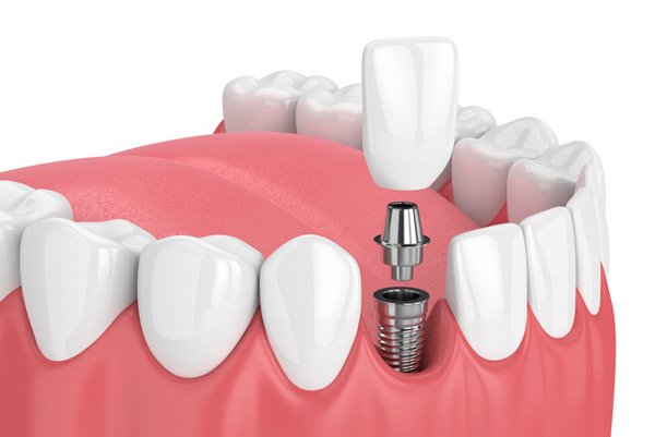 A graphic of the mouth of a candidate for dental implants at Wanserski Dental Center for Complex Dentistry in Wausau, WI