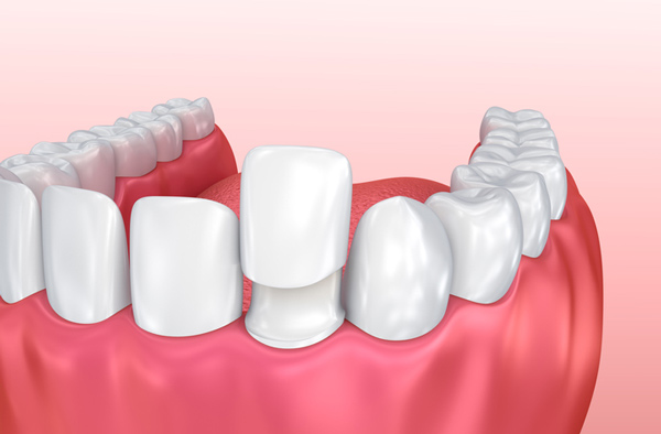 Rendering of a jaw with a porcelain veneer from Wanserski Dental Center for Complex Dentistry in Wausau, WI